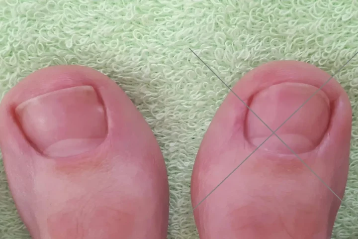 Pedikúra – srovnání správného a nesprávného střihání nehtů